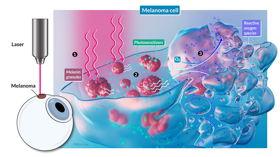 melanoma cell