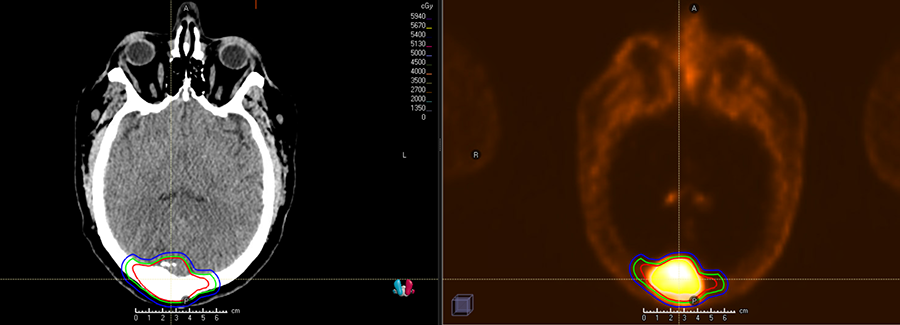 CT scan (L) PET Scan (R)